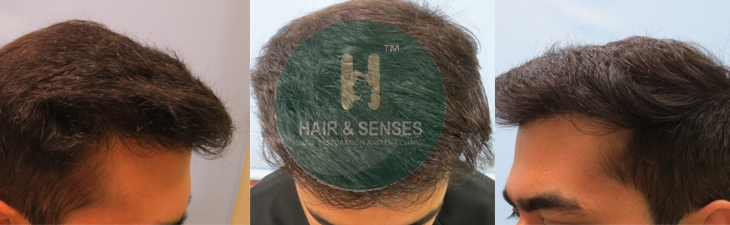 Hair Growth after 8 Months